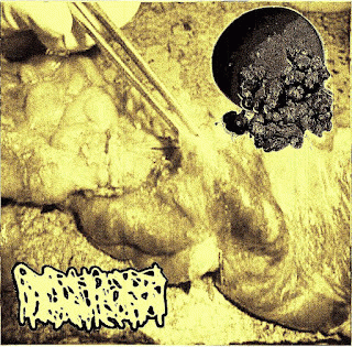 Hydrocephalus : Severe Opioid-Induced Fecal Impactions - Hydrocephalus Hydrocephalus : Severe Opioid-Induced Fecal Impactions - Hydrocephalus